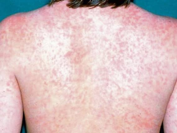 ALERT: Symptoms to watch out for amid measles outbreak in Ireland