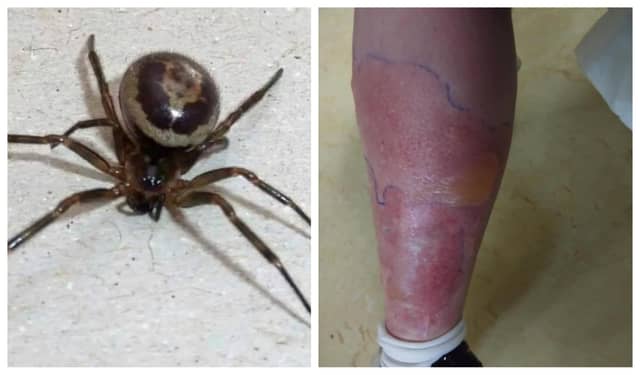 Waterford woman hospitalised for a week after False Widow spider bite