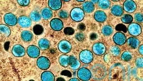 Vaccination advice for groups most at risk of monkeypox in Carlow to be issued soon