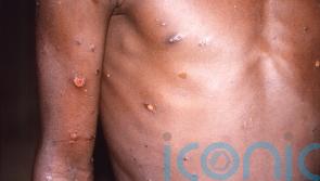 HSE widening rollout of monkeypox vaccine to people in Carlow at high risk