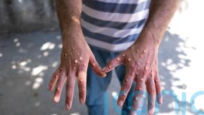 Advisory group on monkeypox will bring additional governance – CMO