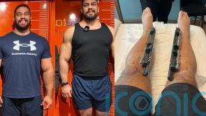 Dad of two spends €100k lengthening his limbs to increase height from 6ft to 6ft 7in