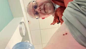 TD bitten by dog while out canvassing for election shares update