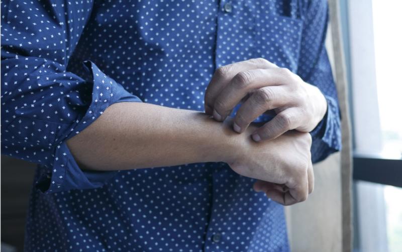 ALERT: Warning issued in Ireland after spike in scabies cases with nasty symptoms