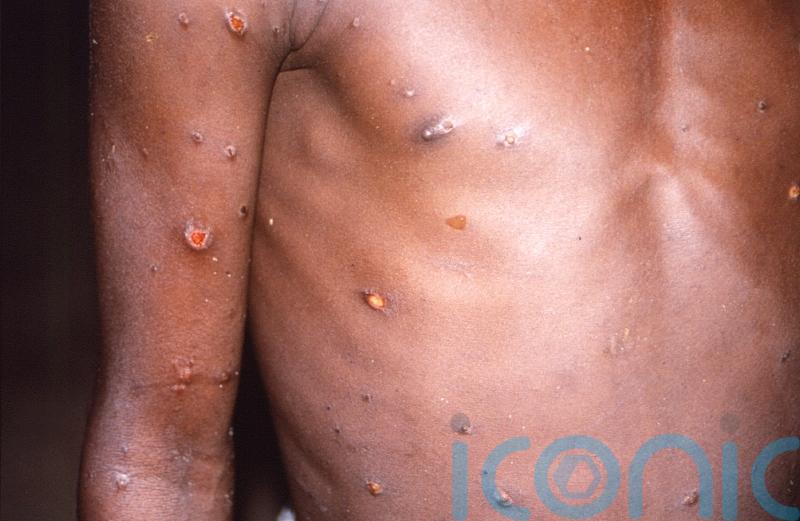 HSE widening rollout of monkeypox vaccine to people in Carlow at high risk